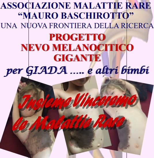 Progetto Nevo Melanocitico Gigante